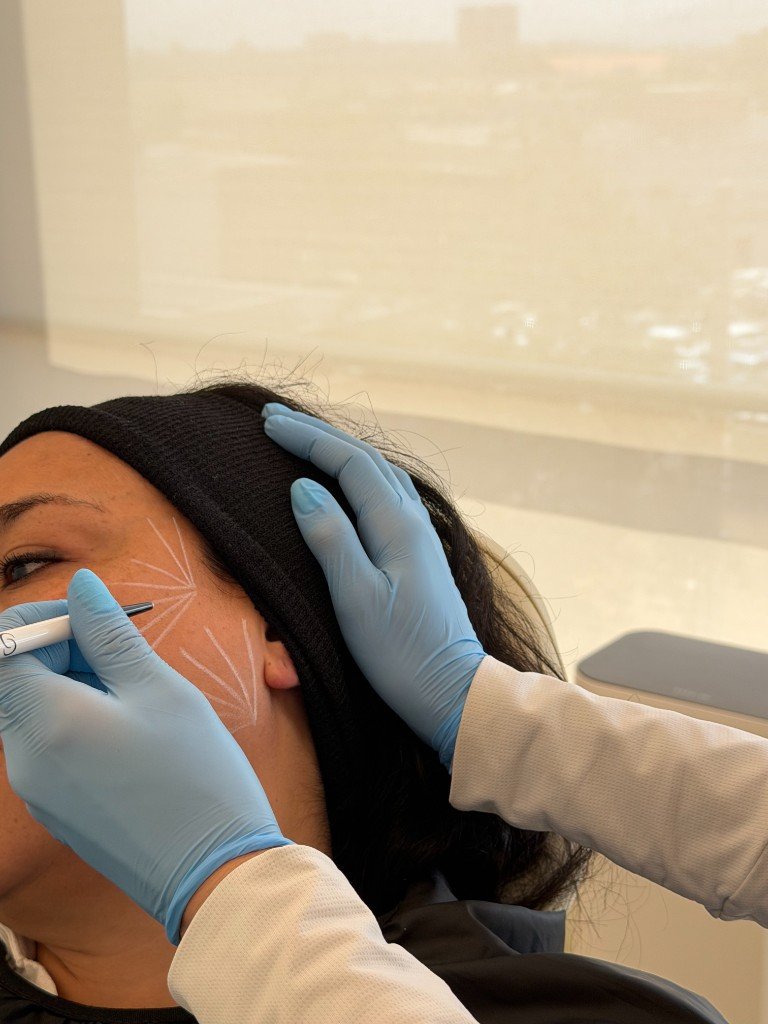 Marcación facial previa a procedimiento estético